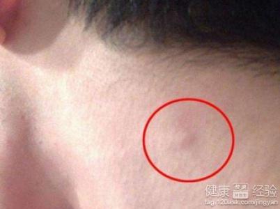 腹部沟酸胀是淋巴发炎吗_腹股沟淋巴结触诊_腹股斜沟疝要不要紧